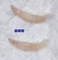 遺残乳歯（犬歯）